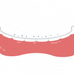 فیکس ریتینر دندانپزشکی ? - نگهدارنده یا ریتینر ثابت ارتودنسی - فیکس ریتینر متحرک ارتودنسی